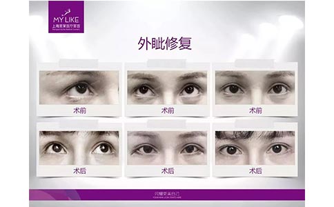 美莱医生告诉你:吸脂手术疼不疼?