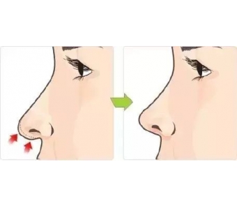 上海美莱微整形玻尿酸丰下巴要注意什么