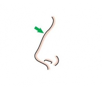 隆鼻,做过假体隆鼻还可以注射玻尿酸吗?