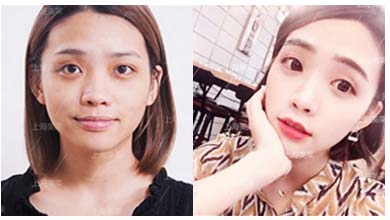 上海美莱腰部抽脂手术,您值得信任与选择!