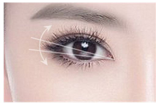 美莱遗传的雀斑可以去掉吗?