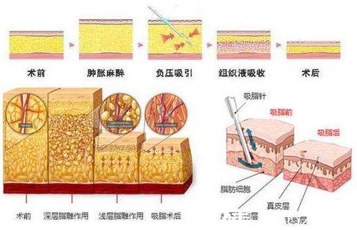 美莱割双眼皮后怎么护理?
