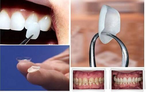 上海激光除皱要多少钱?贵不贵?