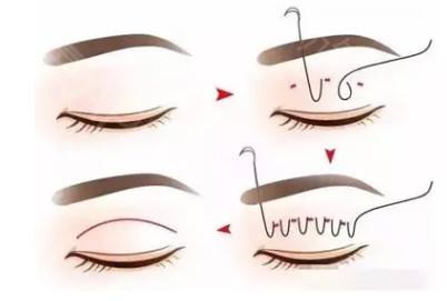 上海自体脂肪隆胸的优势有哪些?