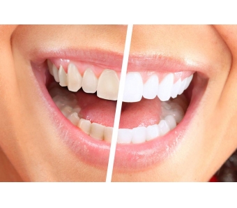 美莱:脸上的雀斑怎么去掉?