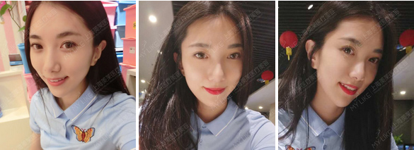 有痘坑痘印怎么修复?美莱激光祛痘坑痘印可以修复!