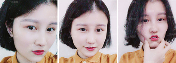 上海激光祛痘后注意什么?