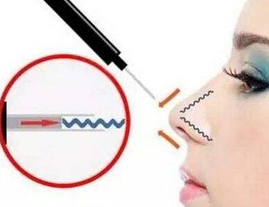 注射瘦脸针多久起作用?