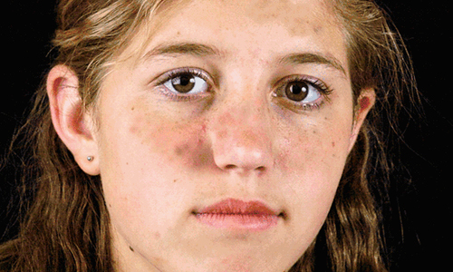 假体隆鼻怎么做的?