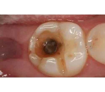 自体脂肪丰胸能一次成型吗?