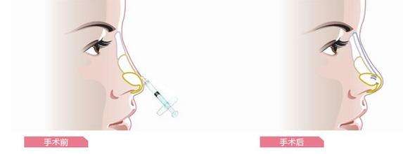 美莱医生告诉你:什么是手臂吸脂?