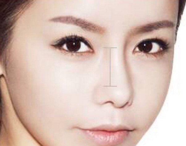 上海双眼皮埋线适合哪些人?