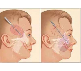 脸上长斑怎么办如何去除?