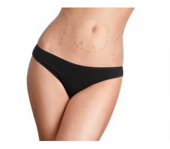 上海割双眼皮要打麻醉吗?