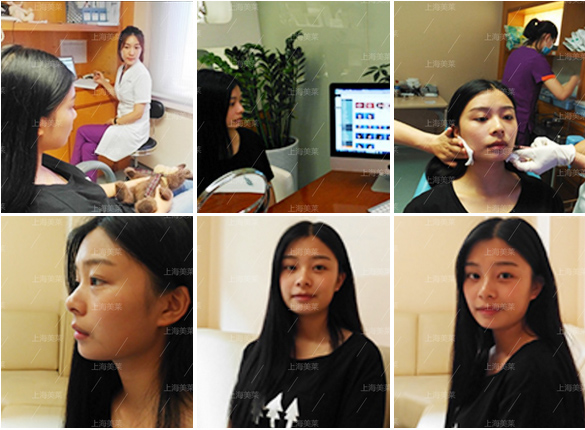 上海皮秒激光祛斑间隔多久做一次?多久做一次比较好?