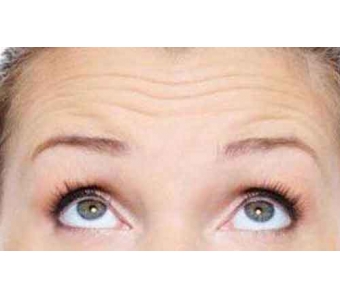 美莱做一个双眼皮埋线能坚持多久