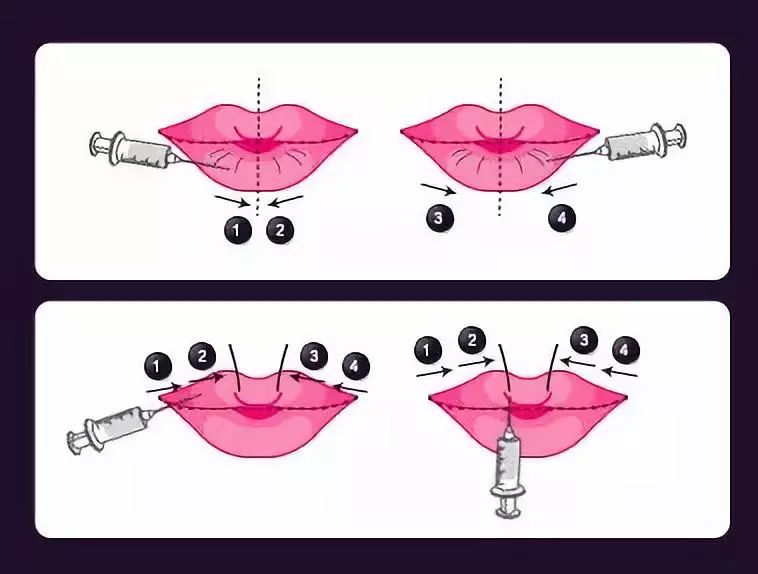 上海做吸脂祛眼袋安全吗?