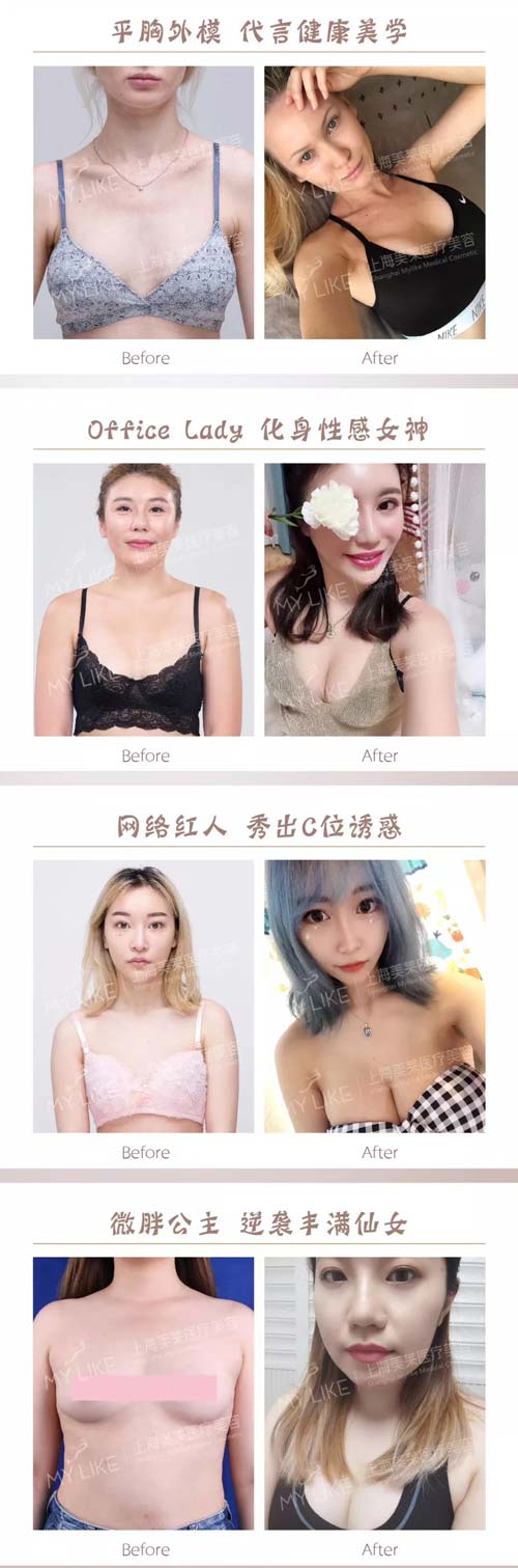 上海蒜头鼻整形有风险吗,风险大吗?