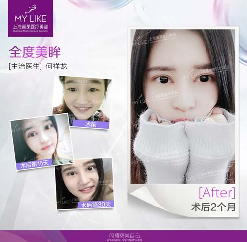 吸脂手术上海哪家好