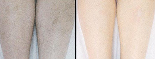 上海做隆鼻手术需要全麻还是局麻