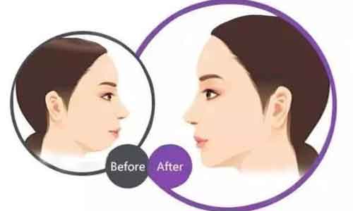 上海抽脂后能吃鱼吗?多吃什么好?