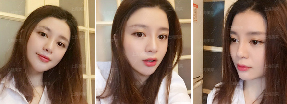 做双眼皮老了会怎样