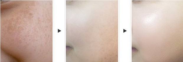 上海做自体脂肪隆鼻的效果如何