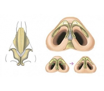 上海鼻尖整形费用和什么因素有关