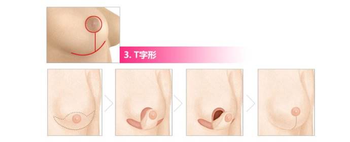 面部吸脂有不好的副作用吗？怎么避免