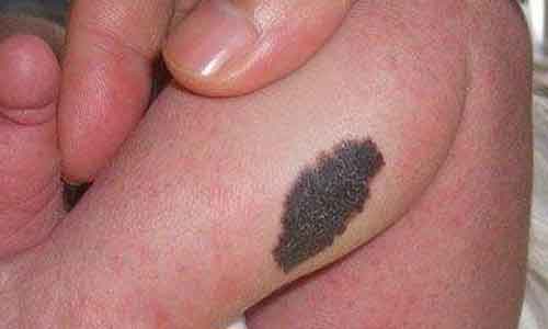 美莱:点痣后要注意什么?