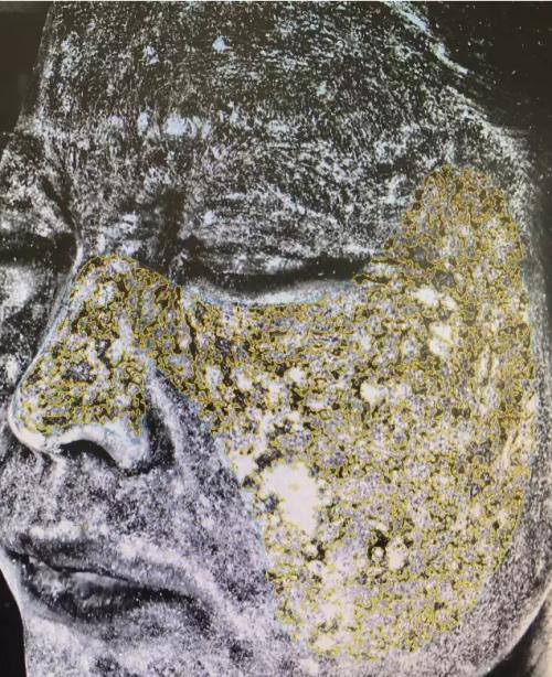 做去眼袋要多少钱,价格高吗?