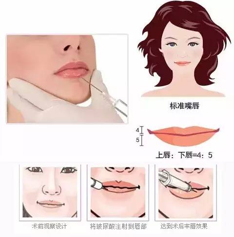 上海硅胶垫下巴可以维持多久,大概几年?