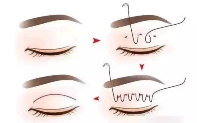 上海硅胶垫下巴可以维持多久,大概几年?