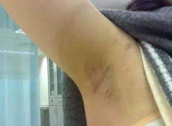 上海产后吸脂减肥副作用有吗