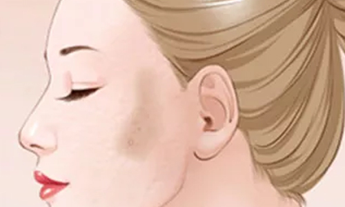 上海假体隆鼻侧睡会歪吗