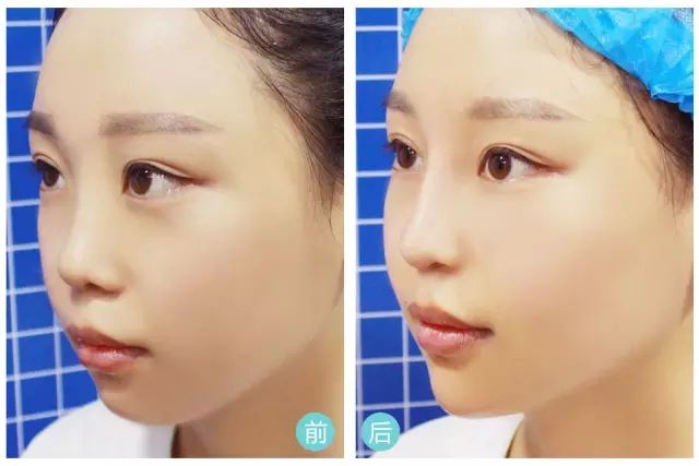 上海打瘦脸针后可以化妆吗