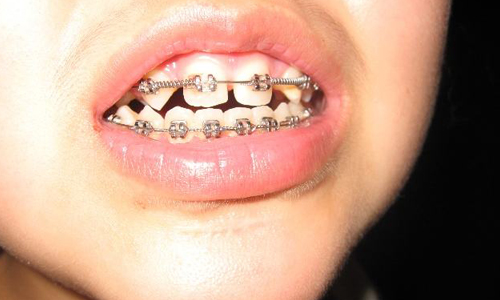 上海鼻头缩小手术恢复时间是多久