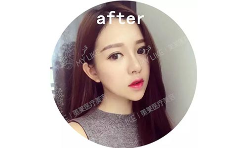 上海腹部抽脂手术安全吗