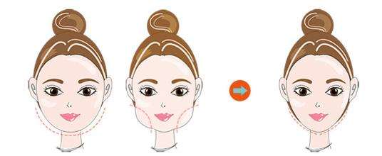 全切双眼皮术前要注意些什么