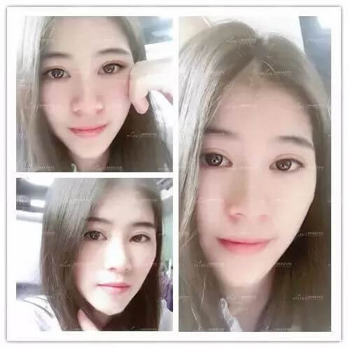 上海做鼻翼缩小手术痛吗