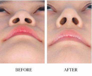 上海埋线双眼皮多久可以洗脸