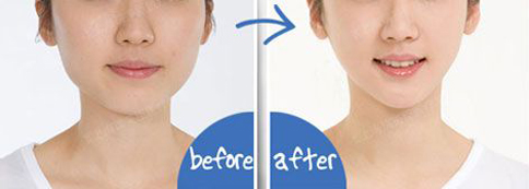 上海埋线双眼皮多久可以洗脸