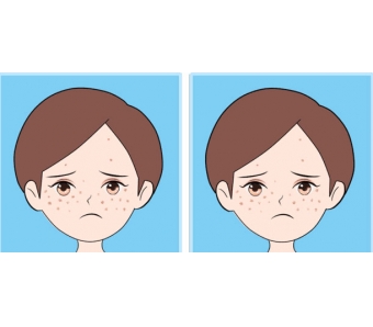 上海双眼皮埋线能管几年