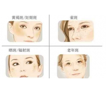 上海祛眼袋后多久恢复正常