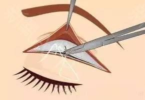 上海埋线双眼皮多久可以洗脸呢