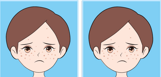 上海美莱痤疮治疗0元案例招募...