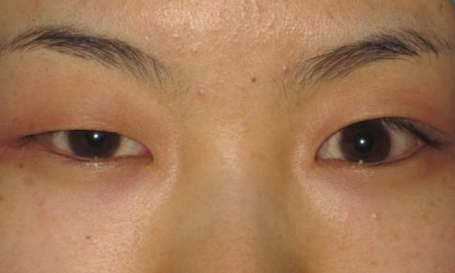 上海做个激光祛眼袋多少钱