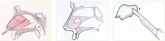 上海玻尿酸注射隆鼻需要多少钱