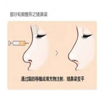 上海玻尿酸注射隆鼻需要多少钱