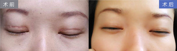 上海割双眼皮几天可以拆线